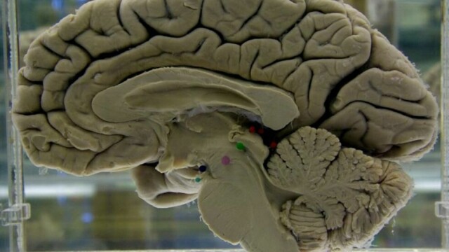 Et snitt av en menneskehjerne utstilt på Museum of Neuroanatomy ved University at Buffalo i Buffalo, New York. Arkivfoto: David Duprey AP / NTB