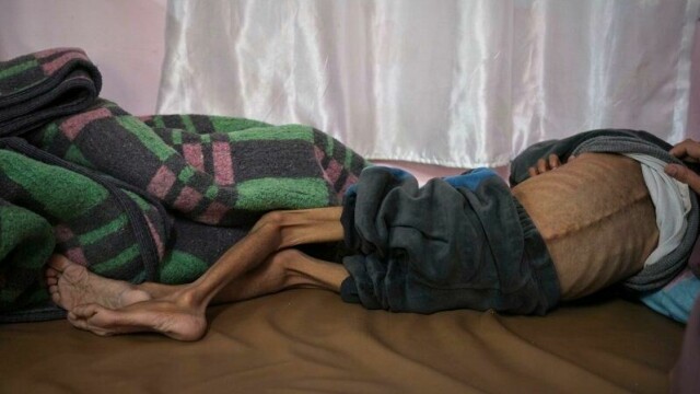 Fem år gamle Osama al-Raqab lider av cystisk fibrose og er alvorlig underernært. Her behandles han på en klinikk ved Nasser-sykehuset i Khan Younis i begynnelsen av mai.