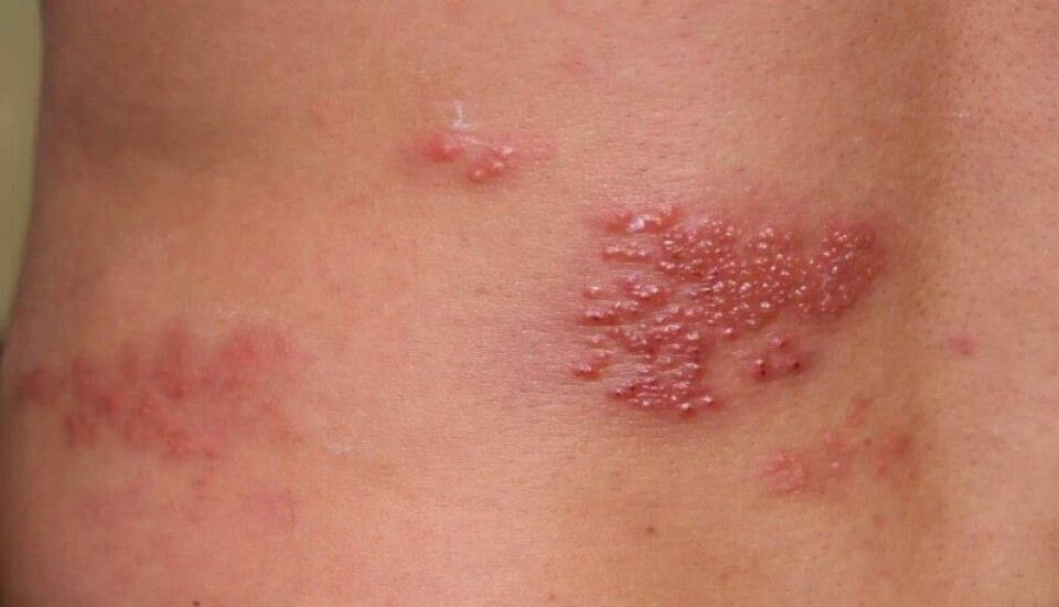 Herpes zoster, også kjent som helvetesild, gir et svært smertefullt utslett. Ifølge Folkehelseinstituttet vil rundt 20-30 prosent av de som har hatt vannkopper, få helvetesild i løpet av livet. Herpes zoster, også kjent som helvetesild, gir et svært smertefullt utslett. Ifølge Folkehelseinstituttet vil rundt 20-30 prosent av de som har hatt vannkopper, få helvetesild i løpet av livet. Foto: Yana UNY / Shutterstock / NTB