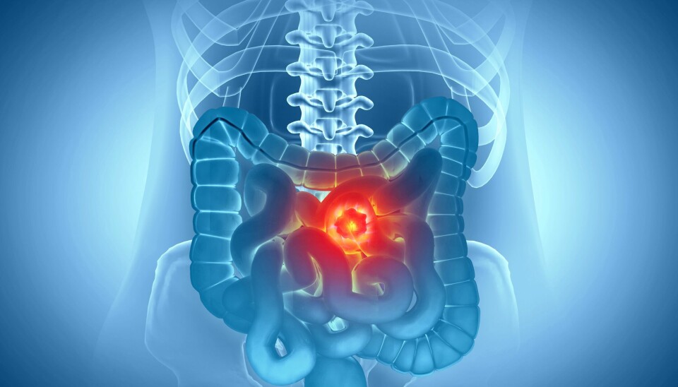 Colon,Cancer.,Cancer,Attacking,Cell.,Colon,Disease,Concept.,3d,Illustration