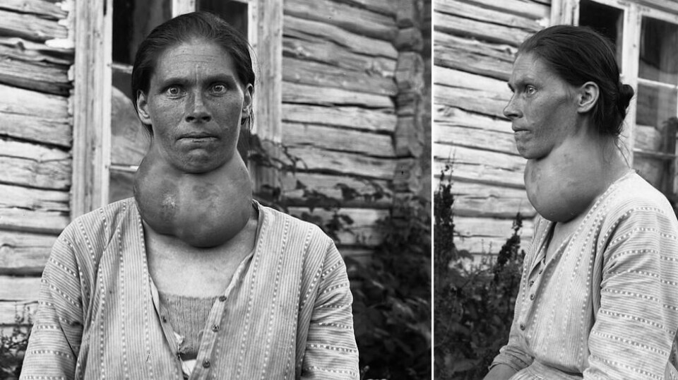 Bildet fra cirka 1910 viser Mina Petersdatter Lundstein, født i bygda Nes på Hedmarken i 1885, som fikk en stor struma. Struma som følge av jodmangel, var tidligere svært utbredt i innlands-Norge, på grunn av lite hvit saltvannsfisk i kostholdet. Nå viser undersøkelser at mange nordmenn får i seg for lite jod, som kan bety flere struma. Foto: Martin A. Finborud / Anno Domkirkeodden