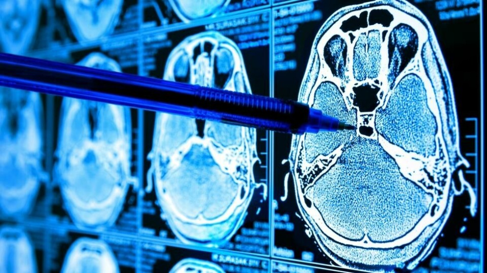 Illustrasjonsbilde. Forskere kan ha funnet sammenhengen mellom langvarige kognitive coronasymptomer og immunsystemets respons.