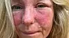 Rosacea er en kronisk hudbetennelse som gir rødflammet hud i ansiktet, særlig i kinnene, på haken, over nesen og i pannen. Solveig Kloppen har delt dette bilde på Instagram. (Skjermdump)