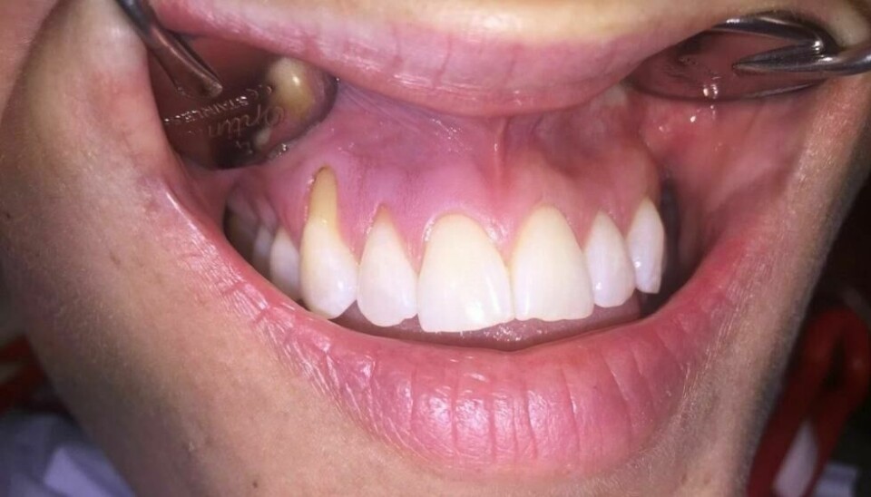 En 20 år gammel kvinne som bruker snus daglig. Du kan se tilbaketrukket tannkjøtt ved hjørnetannen til venstre i bildet. En 20 år gammel kvinne som bruker snus daglig. Du kan se tilbaketrukket tannkjøtt ved hjørnetannen til venstre i bildet. Foto: Simen E. Kopperud / FTHT, FSAN
