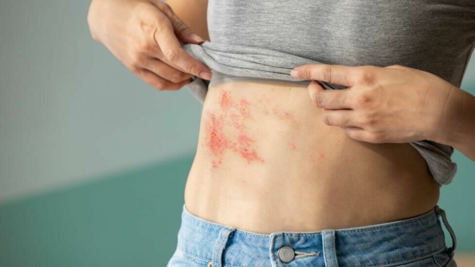 Helvetesild kan ramme mennesker i alle aldere. Helvetesild kan ramme mennesker i alle aldere. Foto: aslysun / Shutterstock / NTB