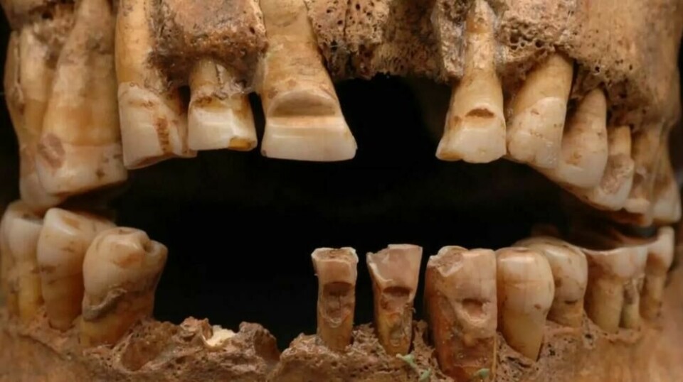 Som du kan se på denne hodeskallen fra en grav på Gotland, er det filet et tydelig spor i fortennene. (Foto: Current Swedish Archaeology / SHM / Lisa Hartzell SHM 2007-06-13 / CC BY 2.5 SE)