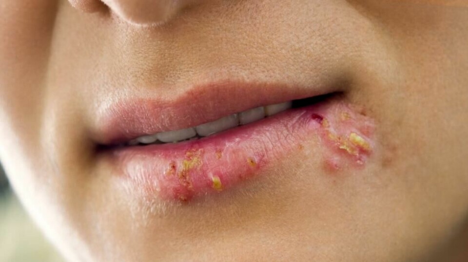 Herpes simplex knyttes til økt risiko for demens.