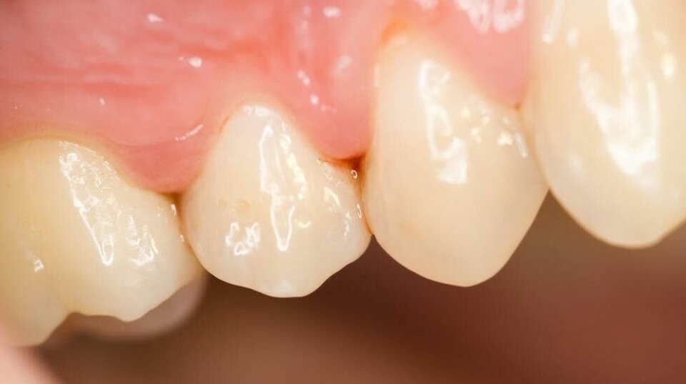 BEVARER TENNENE: – Etter vellykket tannkjøttbehandling har en tann bedre prognose enn et nytt implantat i den samme munnen. Det er det ikke alle som vet enda, det er nytt, sier Odd Carsten Koldsland som er spesialist på periodontitt. Illustrasjonsfoto: Botazsolti / Shutterstock / NTB scanpix