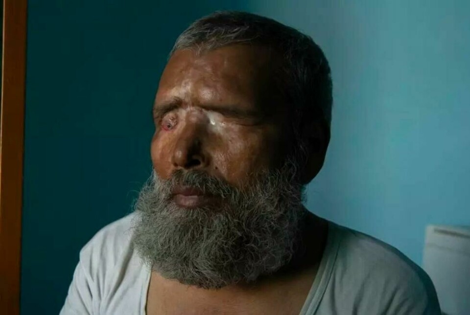 Rasende opprørere tømte syre i øynene hans Mohammad Vakeel og satte fyr på huset til Vakeel. Rasende opprørere tømte syre i øynene hans Mohammad Vakeel og satte fyr på huset til Vakeel. Foto: Showkat Nanda
