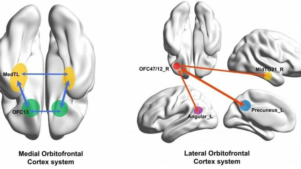 Forskerne fant forskjeller mellom deprimerte pasienter og kontrollgruppen som ikke var deprimerte, i disse områdene av hjernen, som blant annet er knyttet til belønning (medial orbitofrontal cortex) og til ikke å få belønning (lateral orbitofrontal cortex). Illustrasjon: Dr Wei Cheng