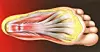 Illustrasjon av senen plantar fascia, som utgjør et bånd mellom hælen og tærne. Når denne senen blir betent, oppstår smerter. Foto: NTB Scanpix / Science Photo Library