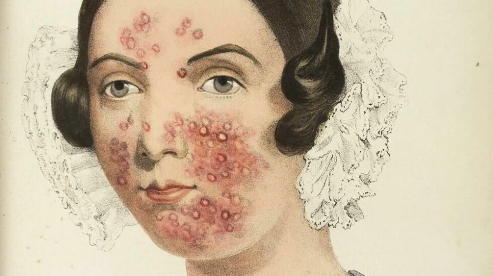 Det finnes mange kjerringråd og myter om hvordan vi kan behandle eller unngå å få kviser. For eksempel at kviser skulle smitte eller skyldes dårlige hygiene. (Foto: Wellcome Library, London / CC BY 2.0)