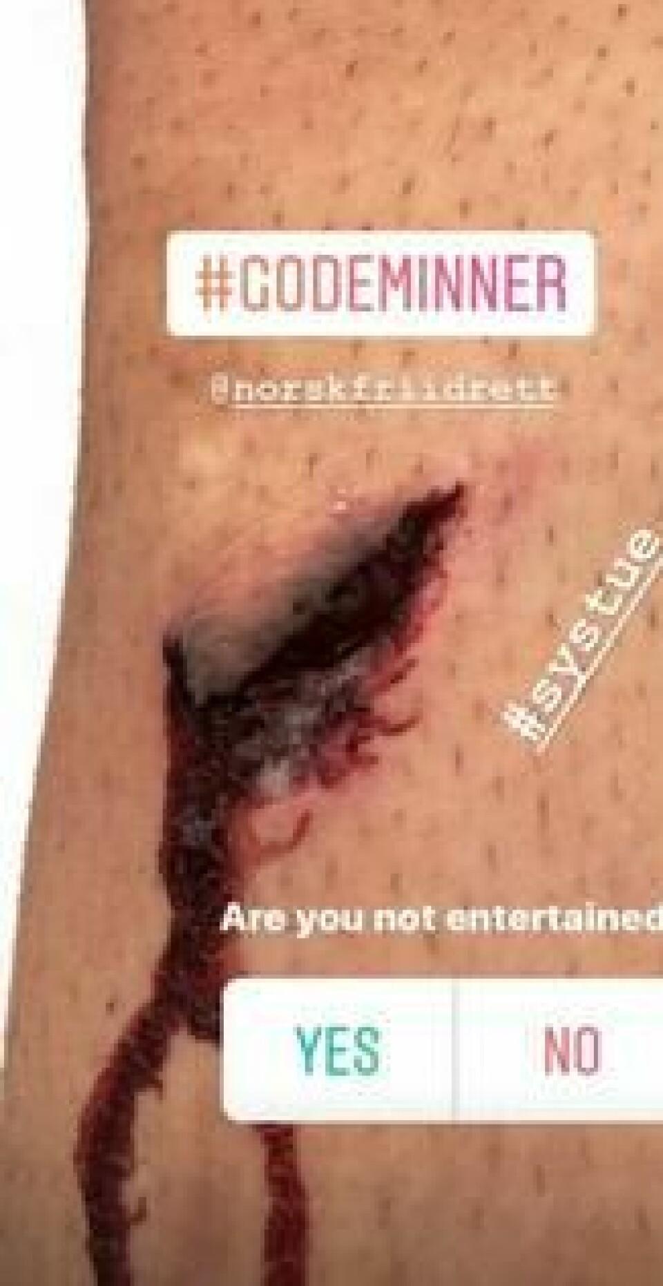 Filip Ingebrigtsen la selv ut et bilde av leggen sin etter fallet på Instagram. Filip Ingebrigtsen la selv ut et bilde av leggen sin etter fallet på Instagram. Foto: Skjermdump Instagram