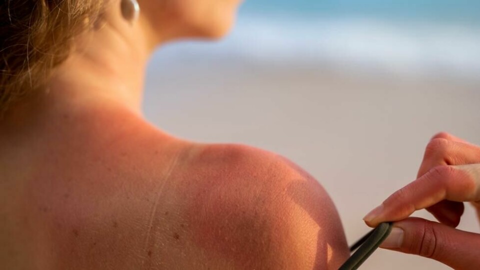 Et solresultat som de fleste vil unngå. Illustrasjonsfoto. Et solresultat som de fleste vil unngå. Illustrasjonsfoto. Foto: James Benjamin / Shutterstock / NTB