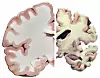 En normal hjernehalvdel til venstre og en hjernehalvdel med langtkommen Alzheimers sykdom til høyre. (Bilde: National Institute on Aging, National Institutes of Health/ Flickr/ PDM 1.0 DEED)