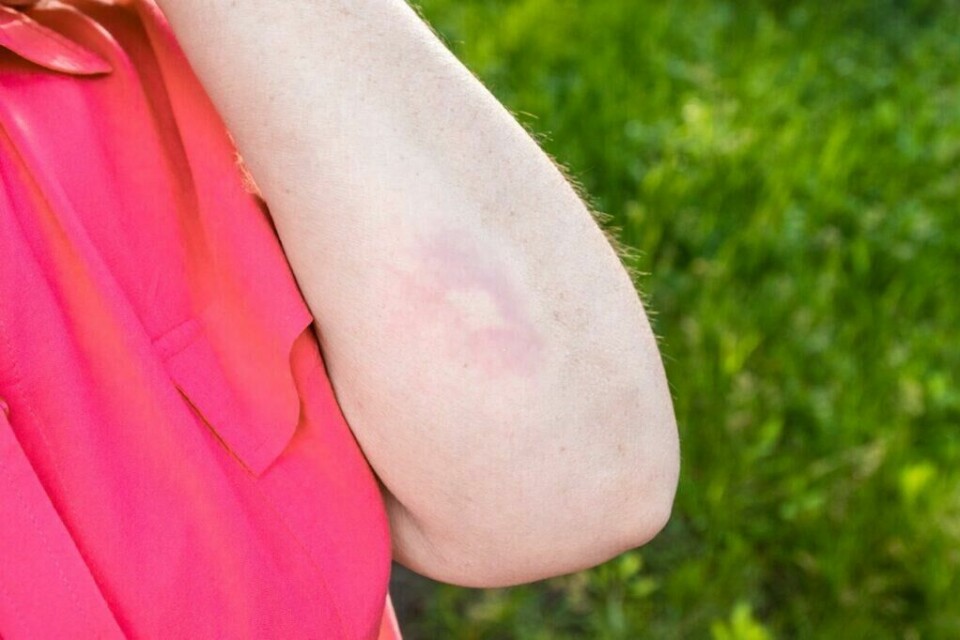 Mosquito bite concept. Healthcare and medical concept (Foto: Colourbox.com) Person stukket av mygg, med myggstikk på underarmen, i rød t-skjorte.